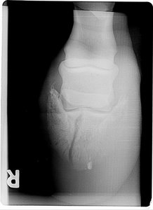 Manuel Hufbeinfraktur000-x640.jpg