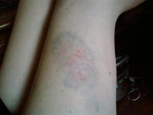 Hundebiss (Klein).jpg